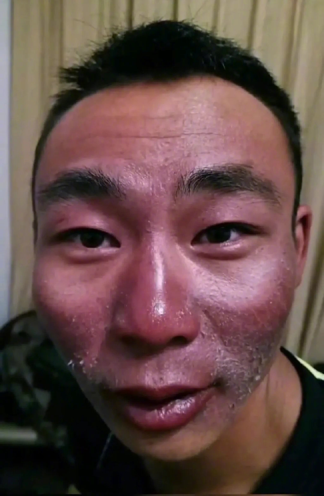 边防军人的脸，心疼！ 突然我想不出来更好的文案了[泪]，我怕文案不够优秀不够优质