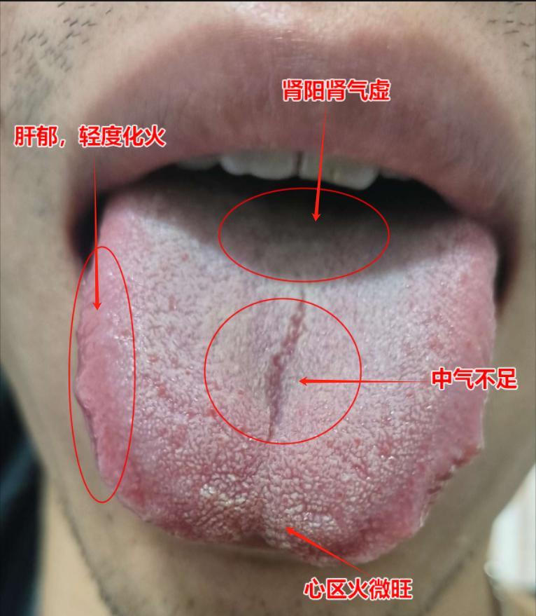 舌两边明显鼓胀，苔白腻，用了逍遥散，真武汤 来“疏肝补阳”没有用？原因就在舌头上
