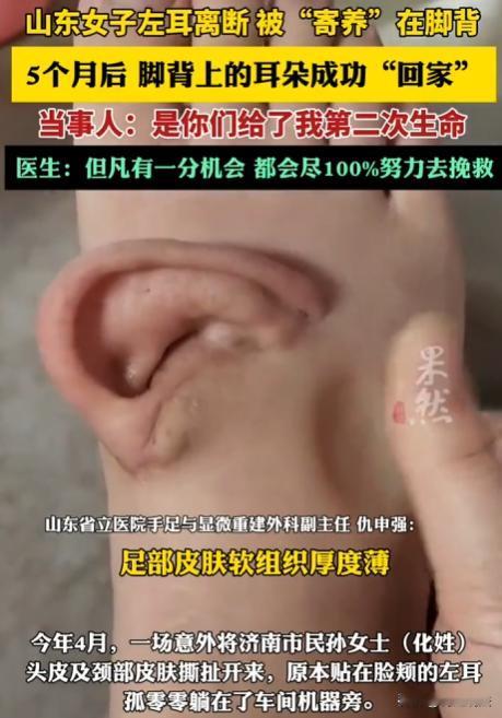 山东，孙女士遭遇意外，左耳与头部完全脱离，头部皮肤大面积撕脱，颅骨都暴露在外。本