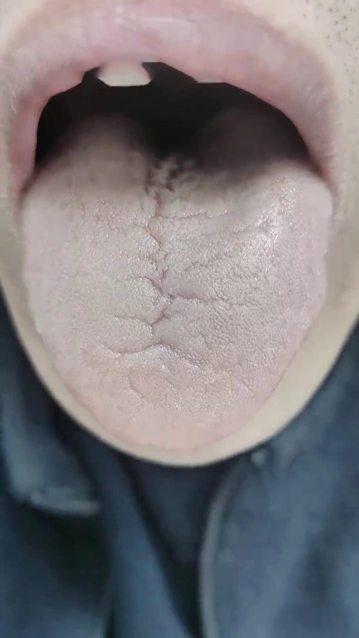 出现这样的舌象，那你就亏虚的就比较严重了！
舌头颜色淡白，舌面裂纹密密麻麻的[泣