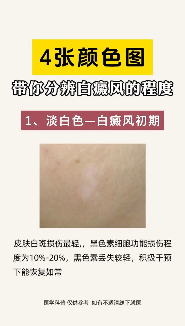 白癜风朋友注意了
