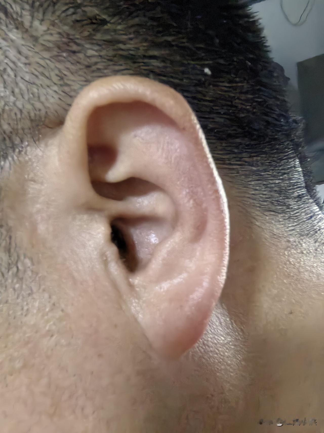 突聋的第180天怎么样了？

自从2025年10月1号右耳突聋到今天已经有了半年