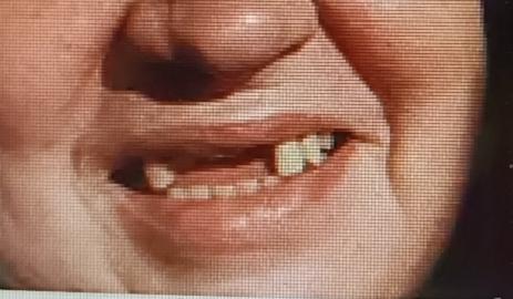 人过60，牙齿掉了就像秋天落叶。很多老人想着赶紧镶牙，恢复吃饭和形象，可有些时候