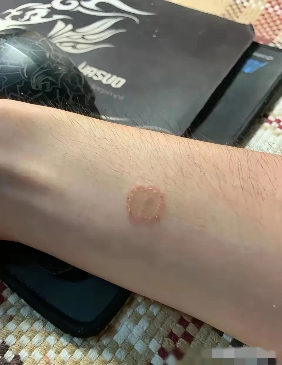 这个月胳膊上突然长出一个小花朵，这是怎么回事？可以用火把它烧死吗？