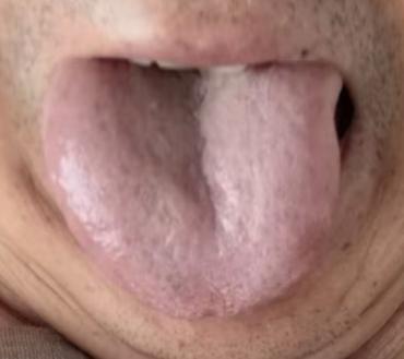 宗筋难起别盲目补肾，根源多为肝血亏虚






对于顽固性的见色不起该如何调理