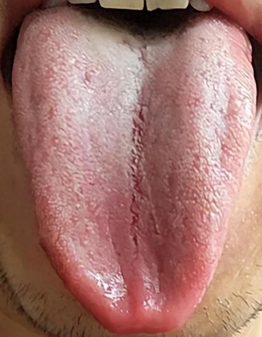 宗筋不起，难以维持，这样的舌头，单纯的补肾是没用的！

这是在门诊上遇到的一位患