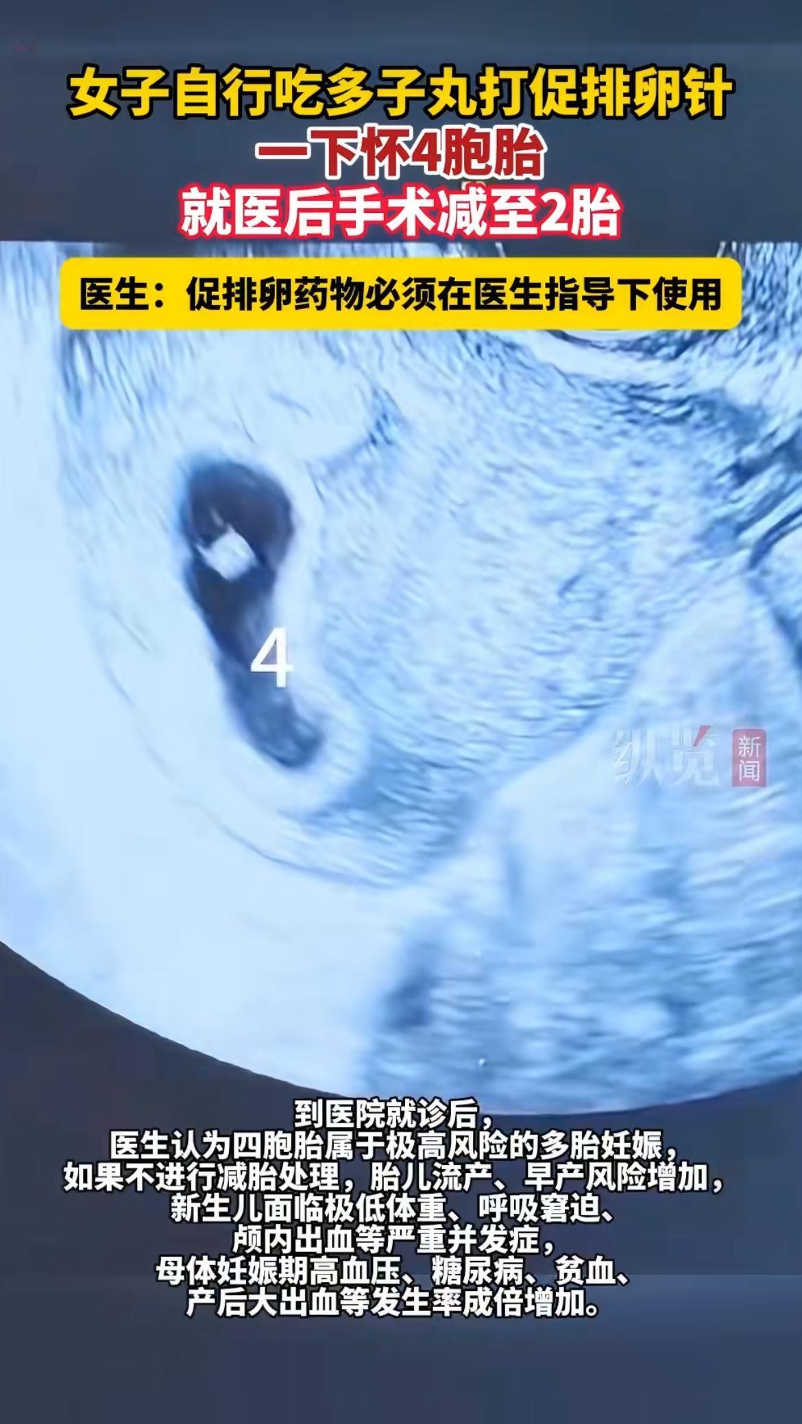 自己吃“多子丸”一下怀了四胞胎，本来以为是天降喜事，结果医生说必须减掉两个，不然