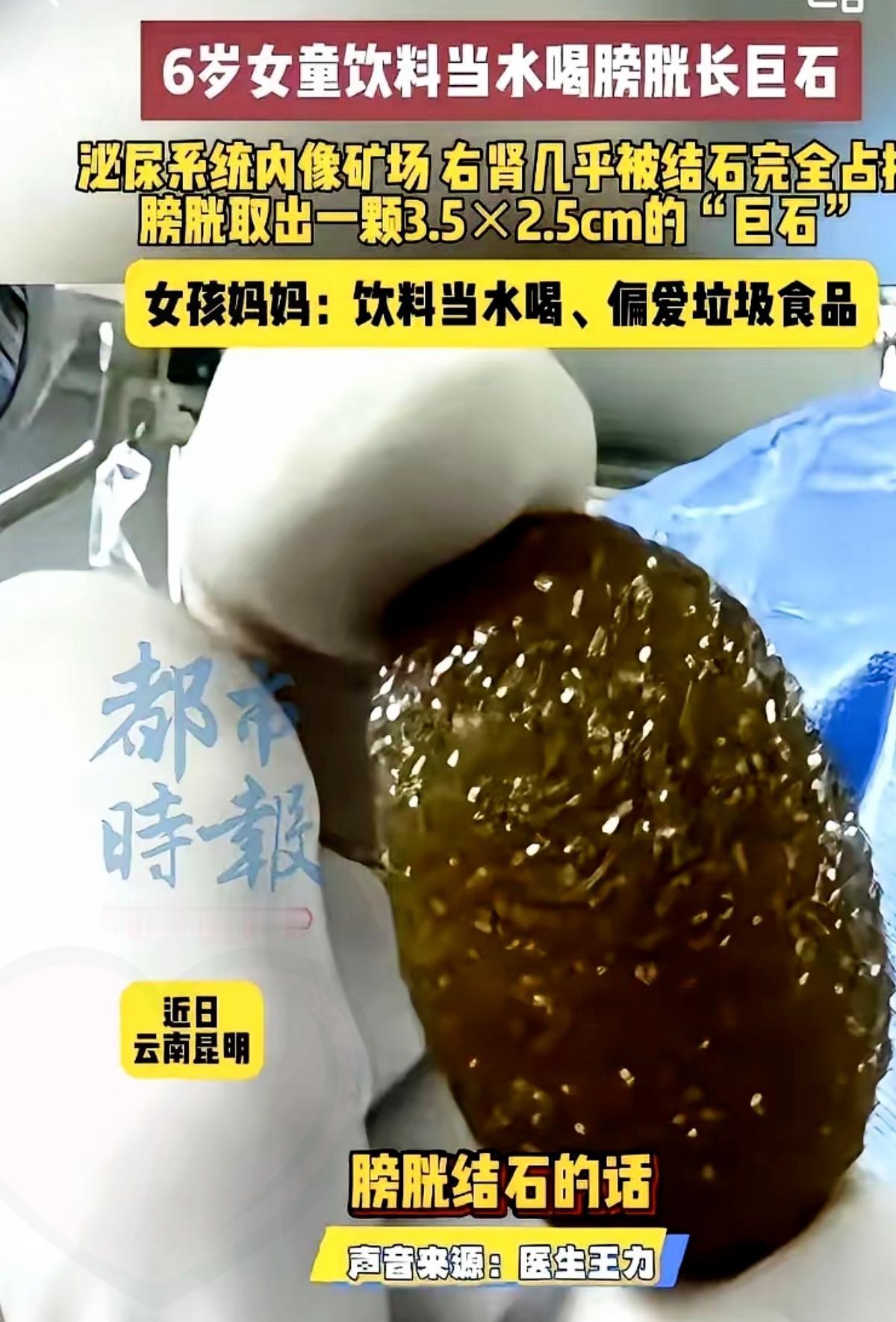 6岁娃尿血查出满肾“鹿角石”，医生直言：都是家长的“心软”喂出来的！
 
   