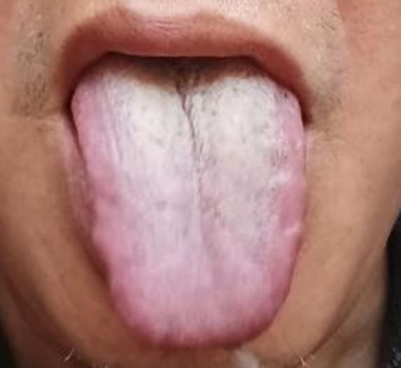 脾胃虚寒，但就是一吃附子理中就上火！如果你也这样，那就是和这位患者犯了一样的错！
