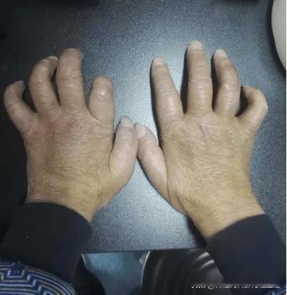 血管一堵，手和脚就容易出现这些问题！看看你有没有
 
1、手脚发凉
 
这是因为