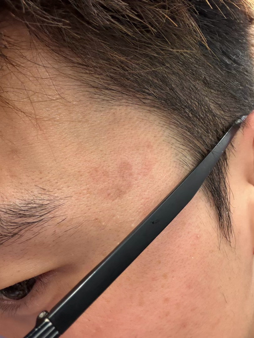 因为摄咖担心失眠最近使用清凉油物理提神涂了三天发现敏感肌已经淤青了[疑问] ​​