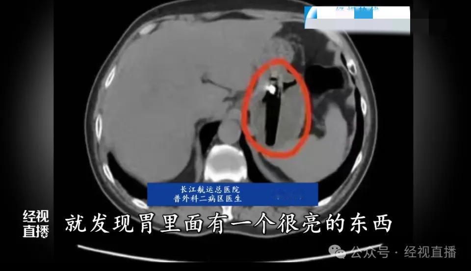 解释不清了！武汉一男子前阵子肚子疼得受不了，跑去医院一查，胃里居然躺着一个打火机