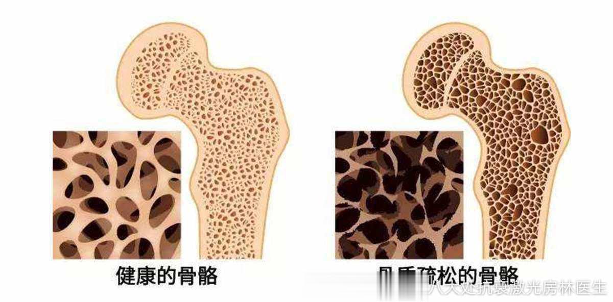 骨质疏松主要跟不良的饮食习惯有着密切关系。如果一个人大量饮酒、吸烟、喝过多咖啡因