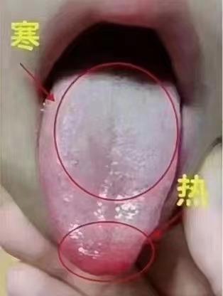 中医上常说一句话：
火往上走，寒往下沉，中焦不通，就会出现“上焦有火，下焦有寒，