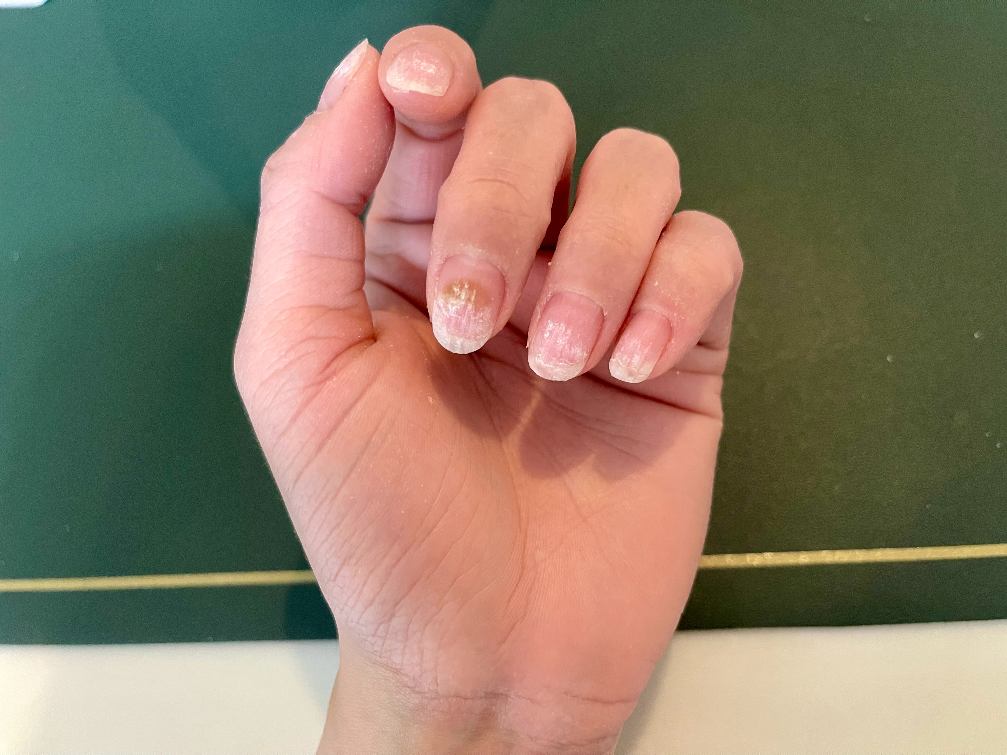 完咯完咯 我也绿脓杆菌了😫美甲jennanni的日常