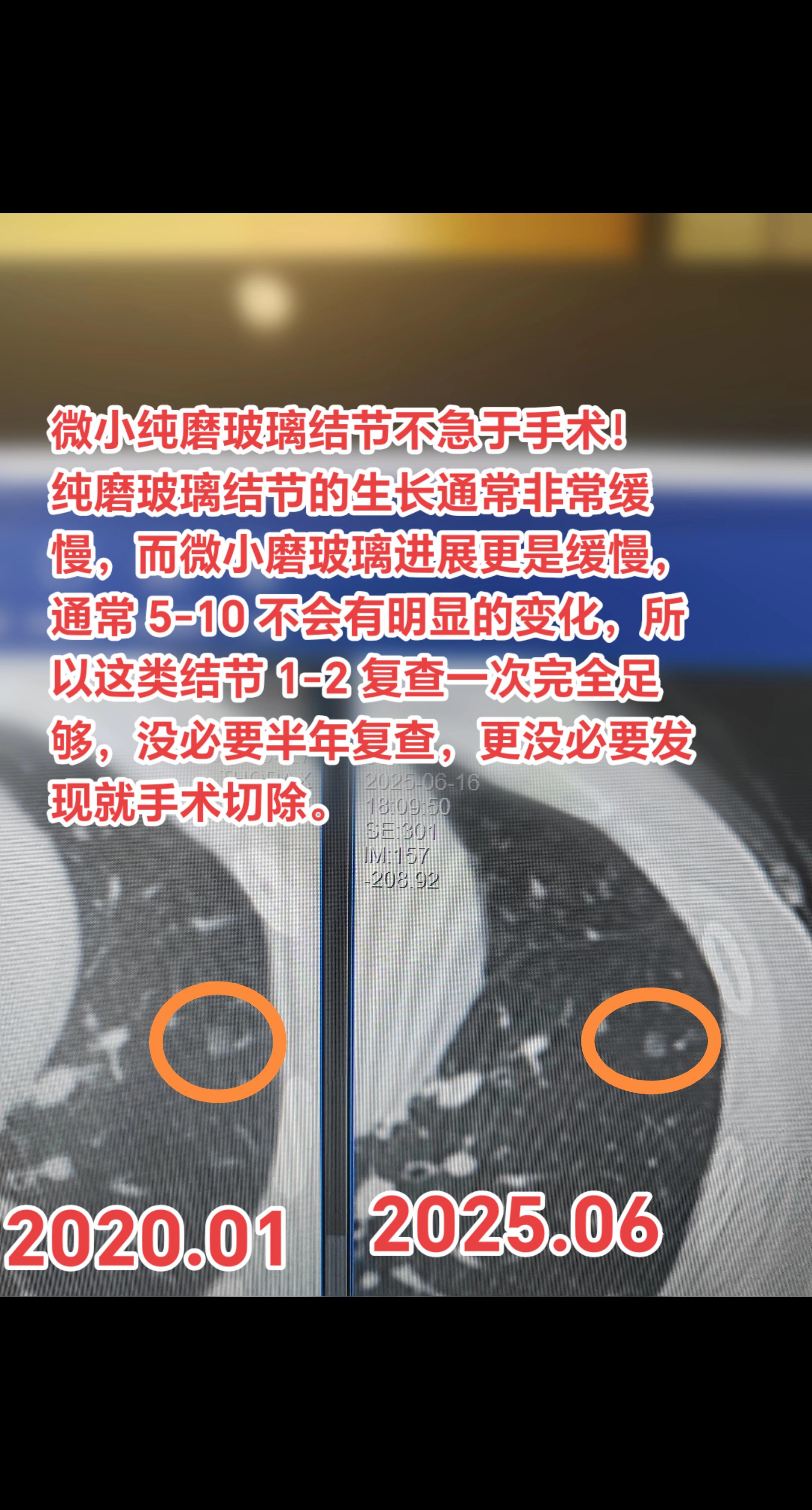 微小纯磨玻璃结节可能会长期不变化！纯磨玻璃结节的生长通常非常缓慢，而微...
