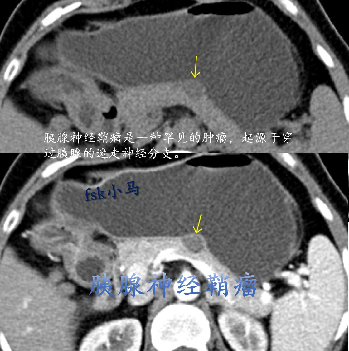 胰腺神经鞘瘤