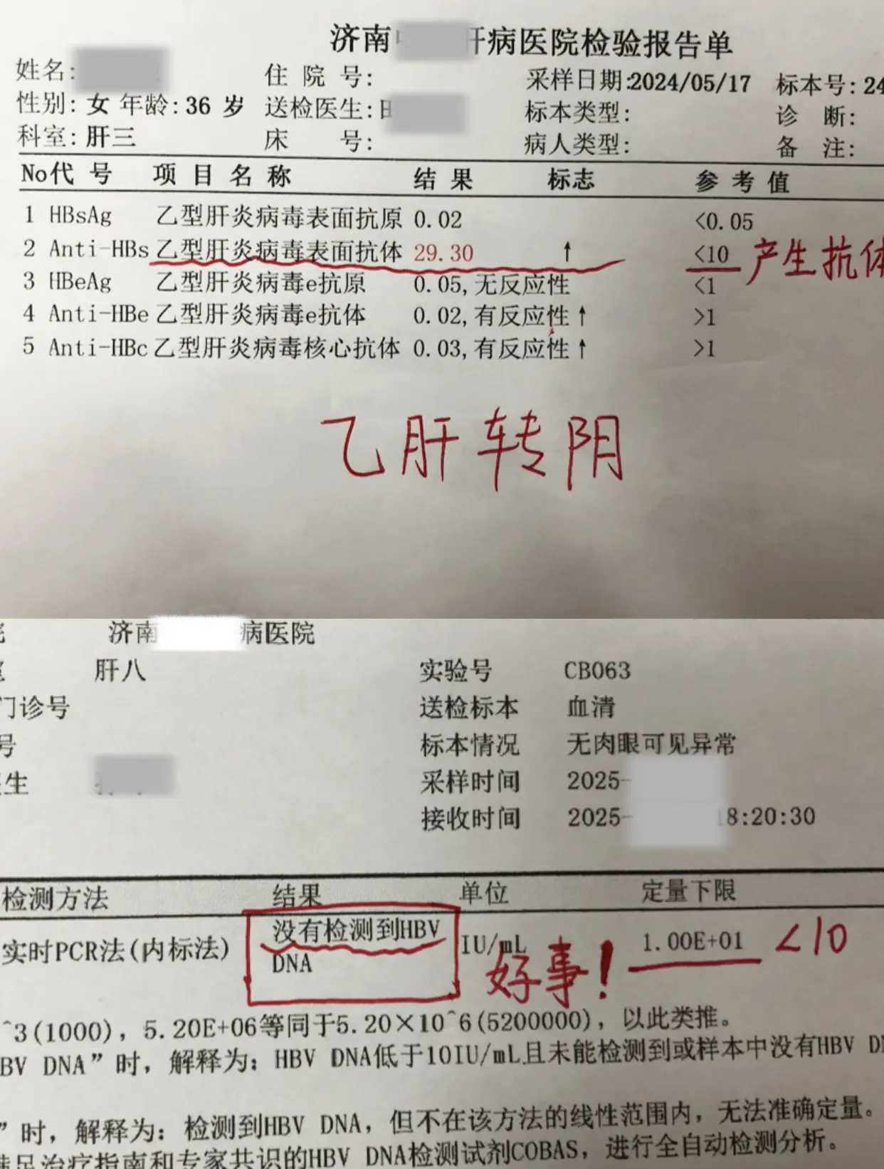 36岁的王女士传来好消息，乙肝小三阳成功实现转阴，病毒检测不到，表面抗...