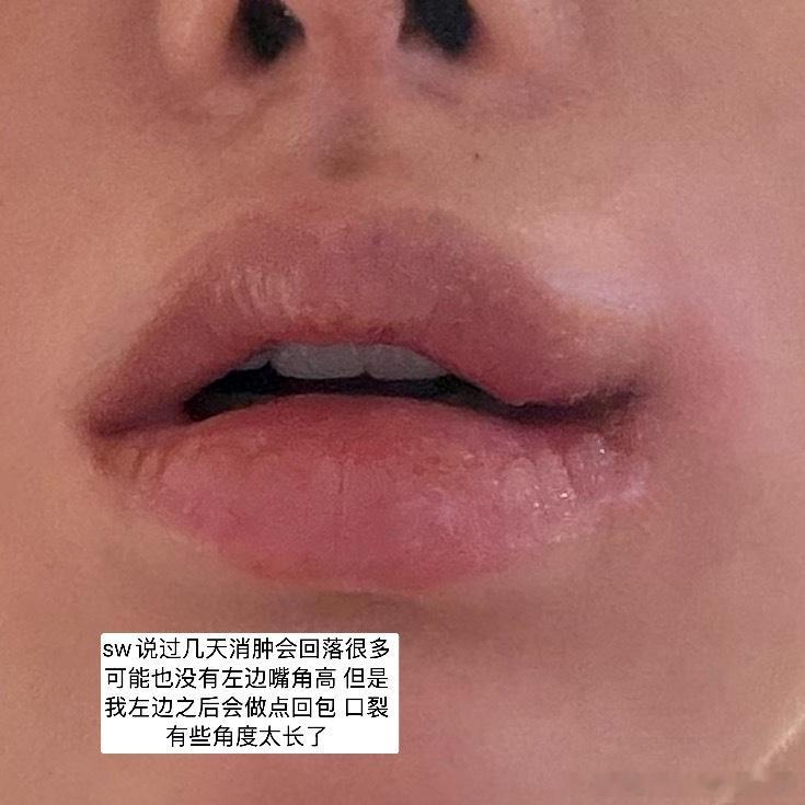 sw真的好谨慎 人真的很好 找的嘴角模版都是平行嘴角 顺便可以看到人中疤痕 就这