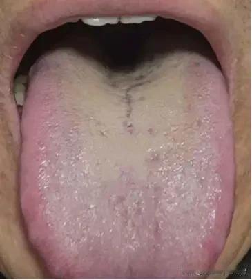 中医：男人行不行，先看舌根有没有裂纹，再看舌根舌苔净不净！
 
大家好，我是陈大