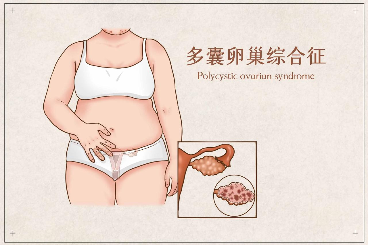 现在多囊卵巢综合征（PCOS）越来越“偏爱”年轻人了，不光成年女性会得，好多十几