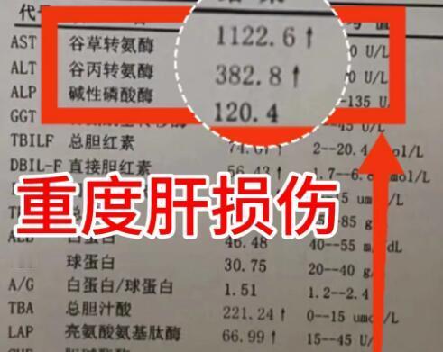 转氨酶升高如何快速降酶？
1、转氨酶升高不超过1.5倍：这种升高是一过性的，主要