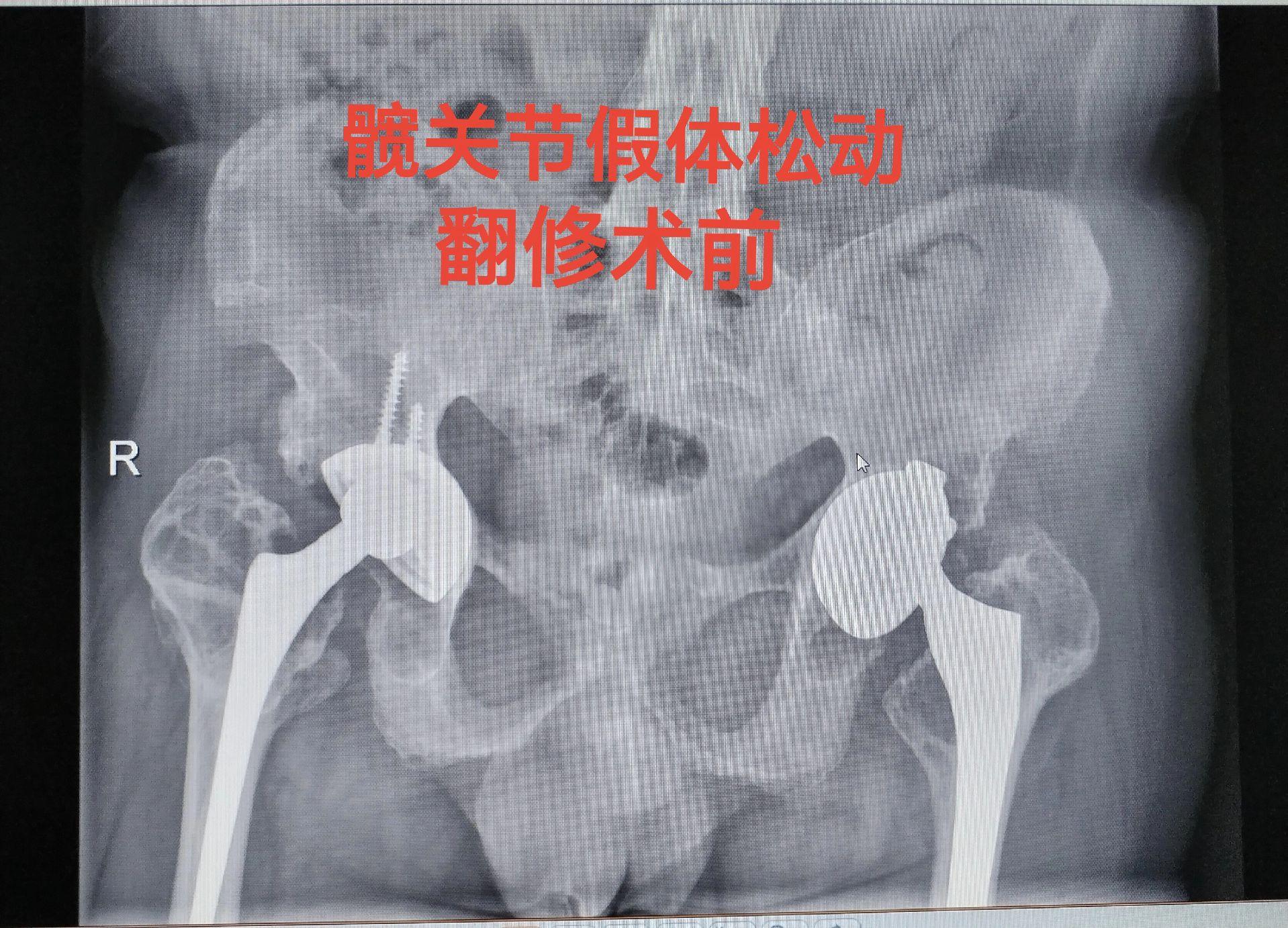 髋关节翻修术。髋关节置换术后假体磨损松动，双侧分次翻修。