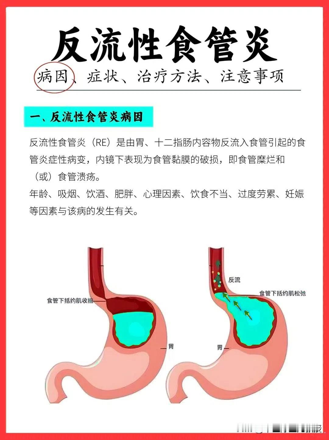 反流性食管炎，病因、症状、治疗方法及注意事项，一文给你讲明白！