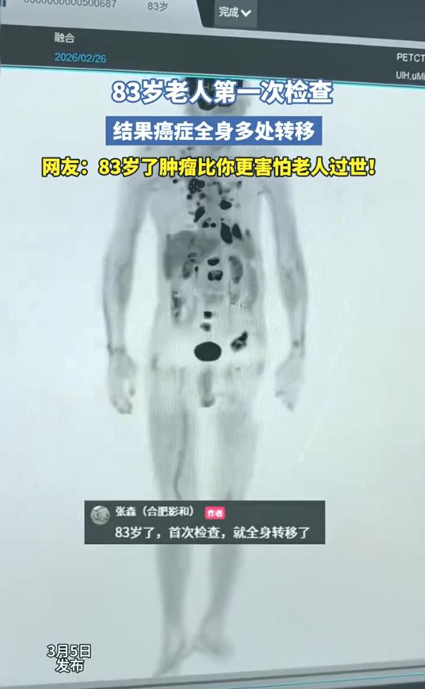 岁数大也有岁数大的好处！安徽，一位83岁老人第一次做全身检查，结果片子上显示，老