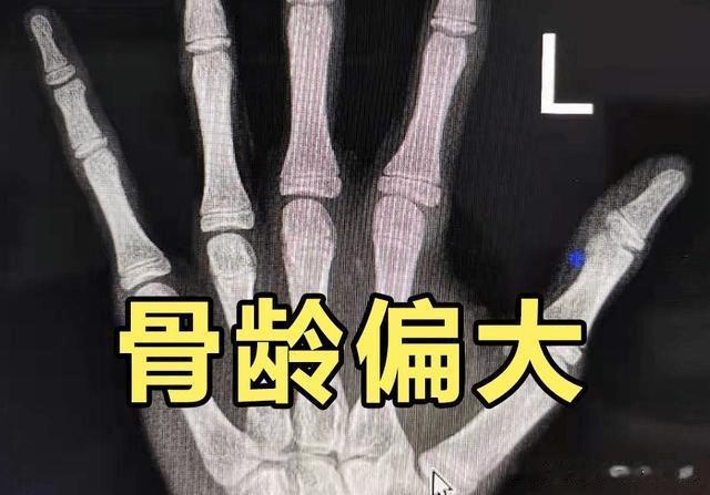 骨龄偏大2岁，终身高只能长到152cm？幸好干预及时，有望长到160cm！

孩
