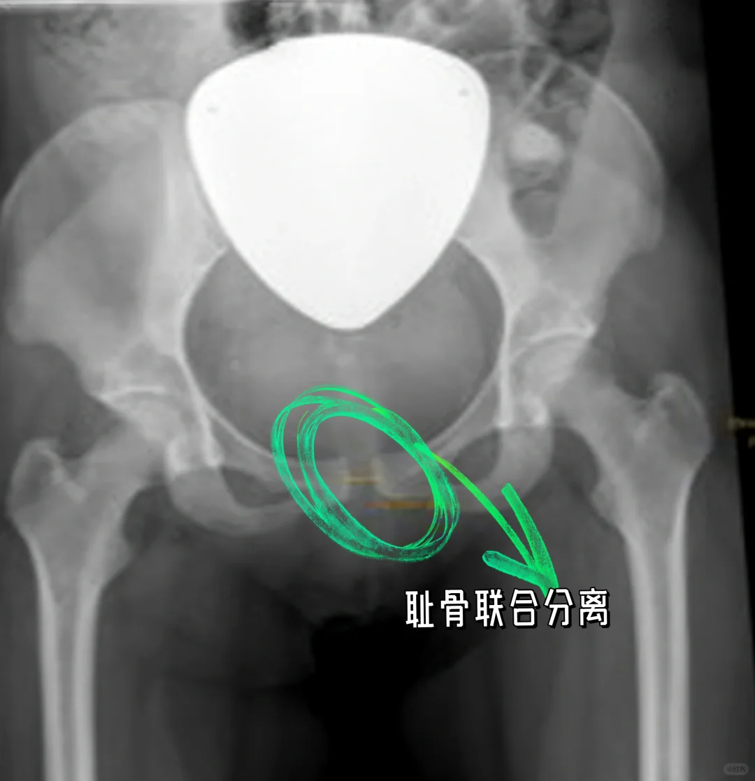 终于有人把耻骨联合分离讲清楚了！