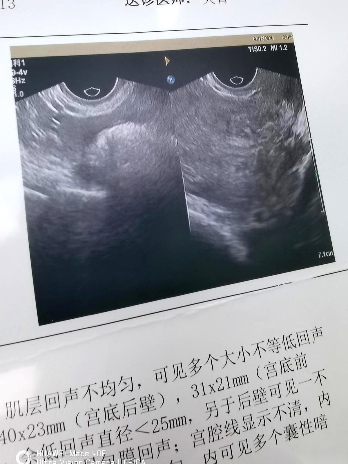 48岁，她把那张检查报告单捏在手里，指尖都白了。
对面的医生，先是指了指片子上的