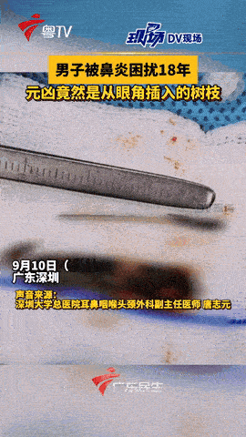 “不幸中的万幸！”9月，广东深圳，一男子身患鼻炎18年，因为复发太严重，就前往了