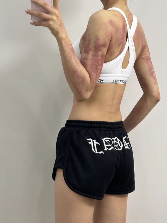 没人疼就去刮痧啊 刮完浑身疼