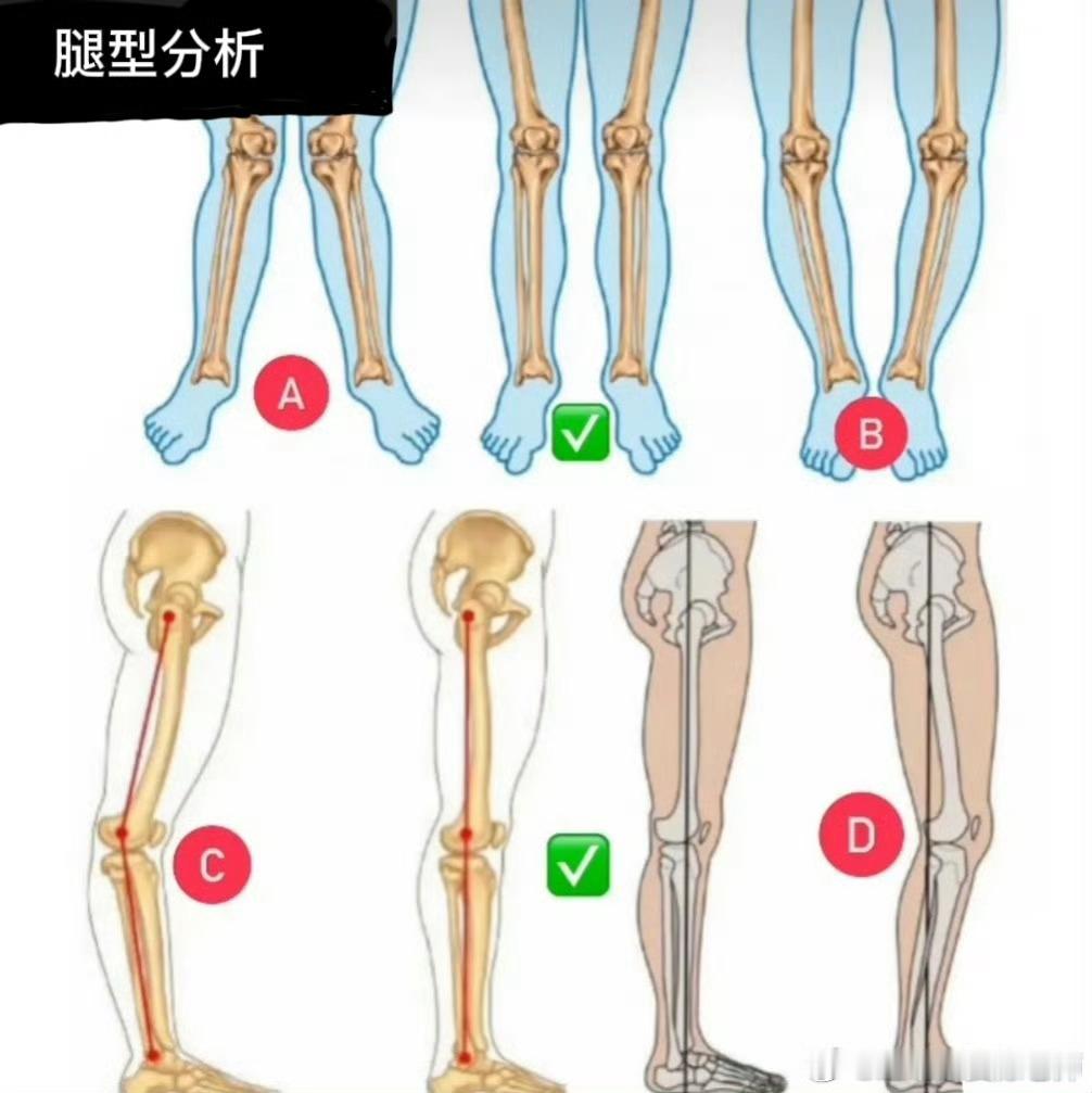 #膝关节损伤# 你的下肢力线，也会引发膝盖疼痛，两者息息相关。来观察一下自己，a