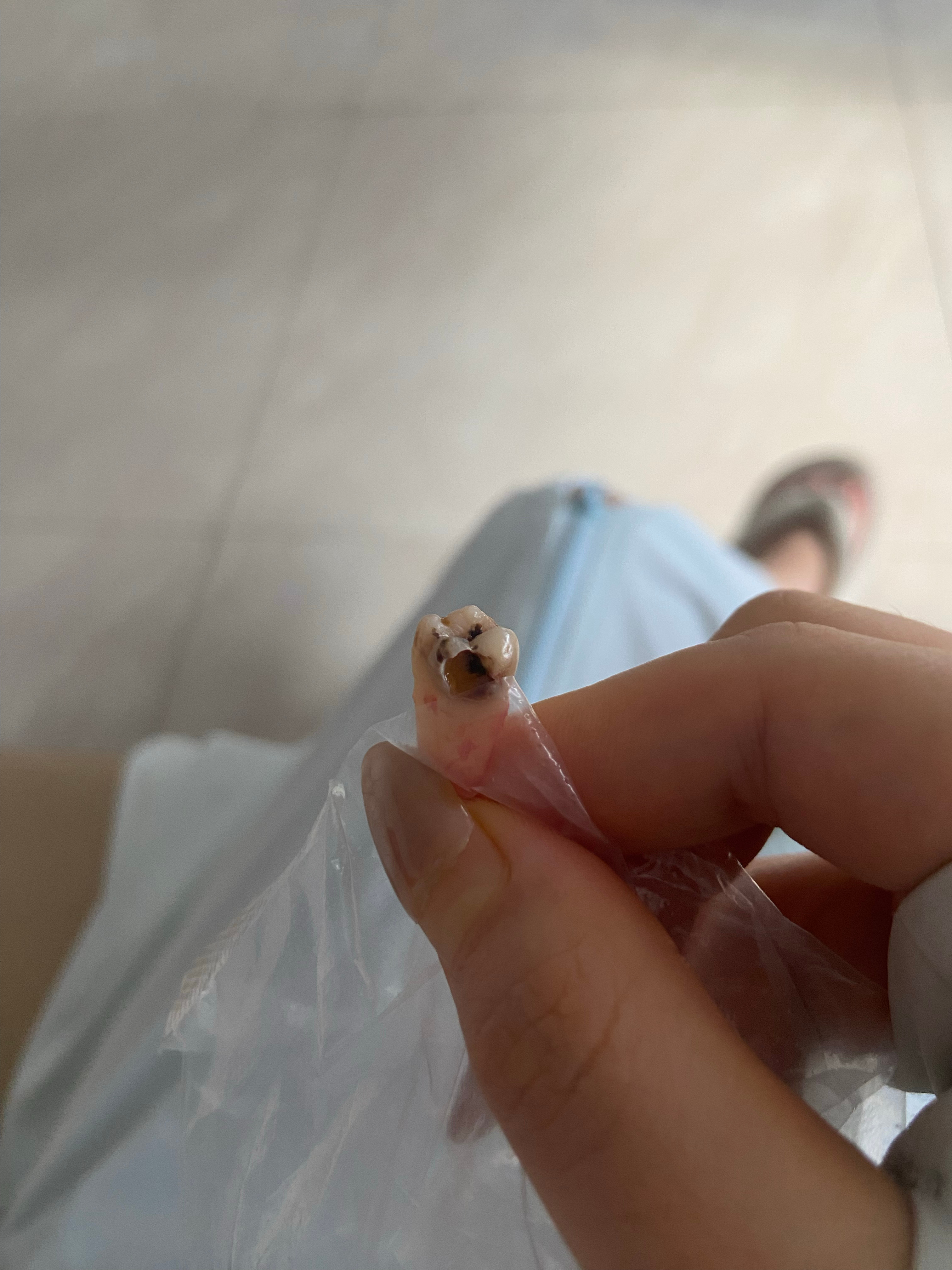 没想到拔智齿只要3s[笑cry]而且一点都不疼[笑cry]反而是打麻药的时候疼[