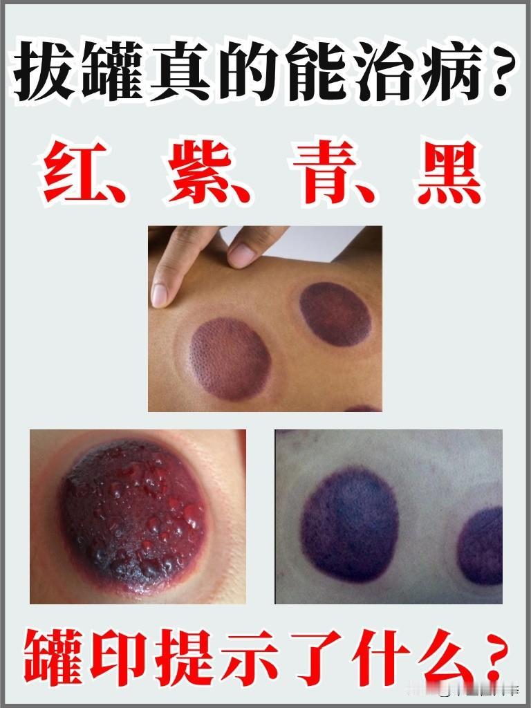 拔罐留下不同颜色的“罐印”，都提示你什么？寒、热、湿、虚怎么分辨？一次讲清！