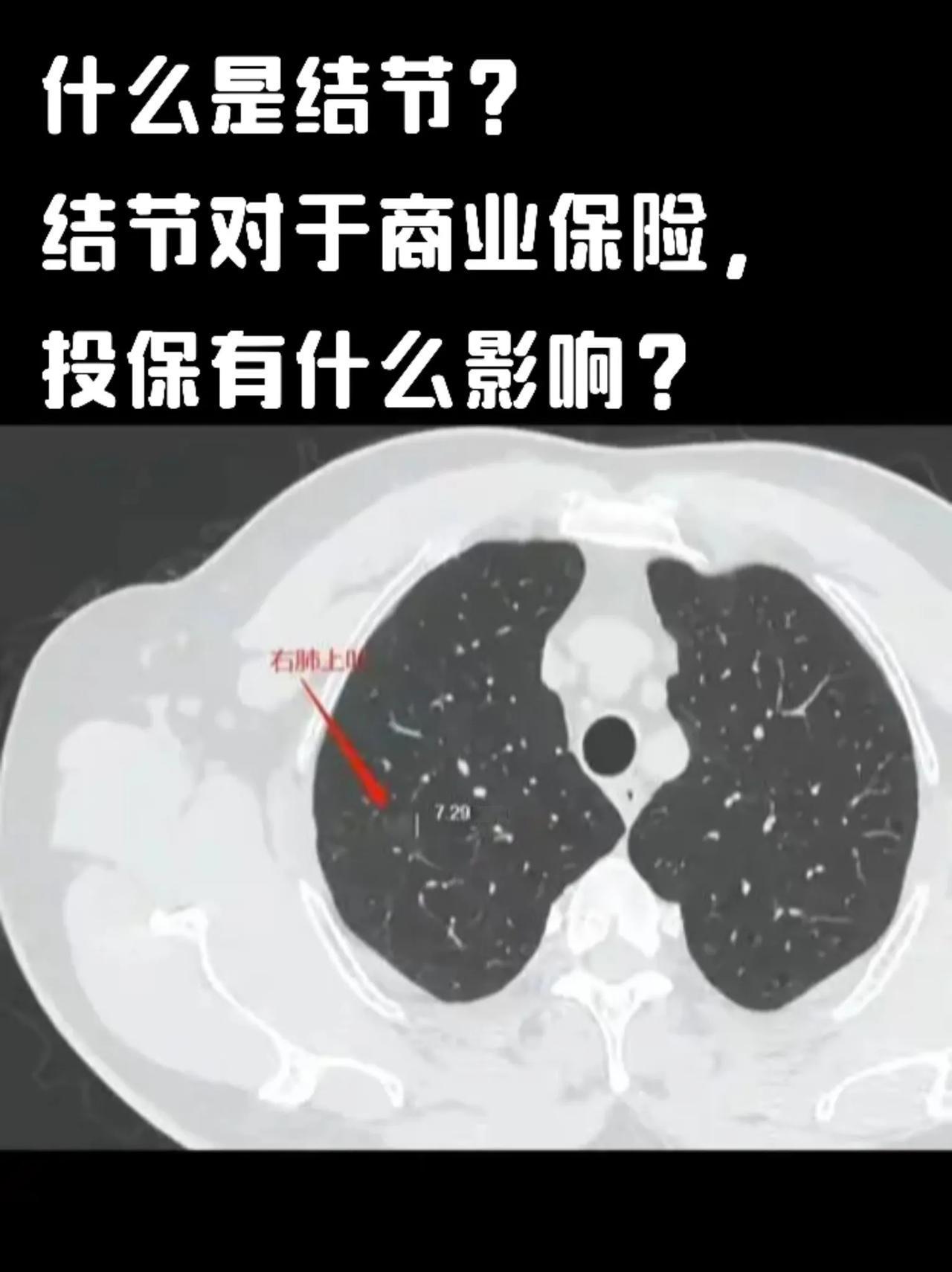 什么是结节？
结节对于商业保险投保有什么影响？

一、什么是结节
 
结节是可触