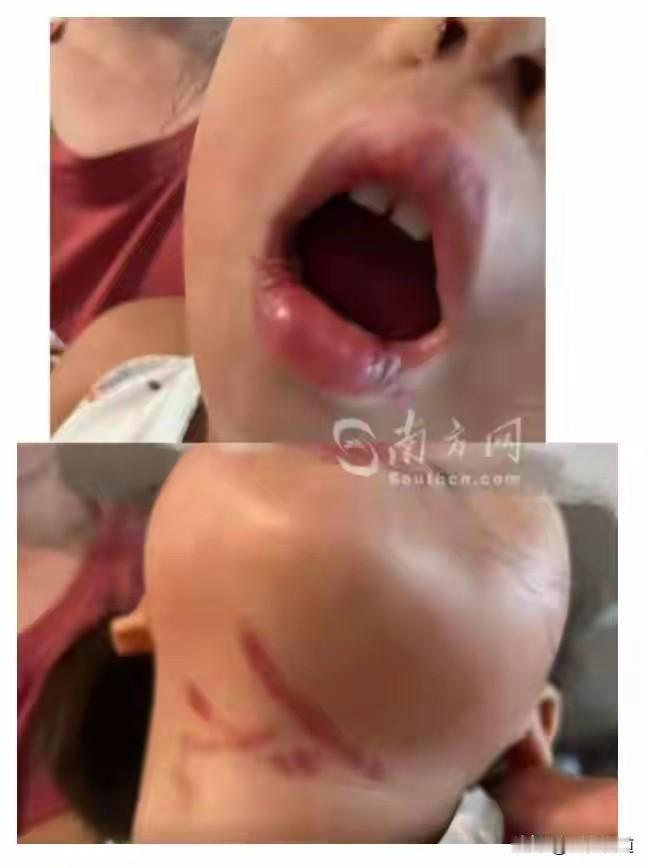 幼儿园老师暴力喂食，往嘴里硬塞，身上多处伤痕，这样的人怎么能当老师，怎么能当幼儿