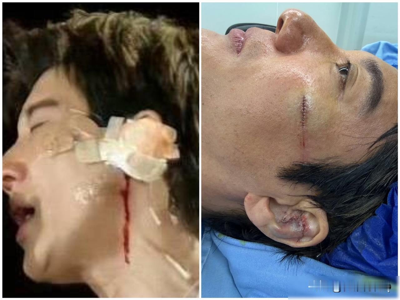 舞台上摔了一跤就缝了七针是表皮损伤吗？把隐藏着的风险都给揭穿了三道黑色警报线，并