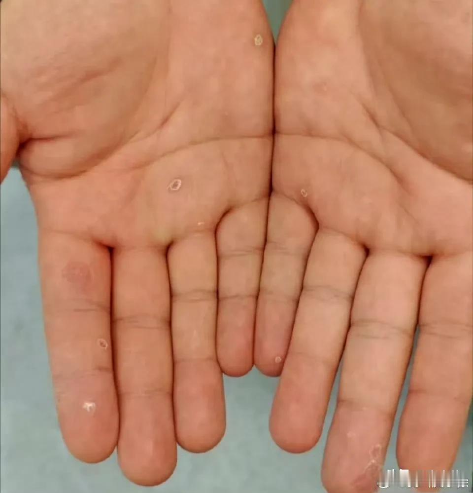 梅毒是经典的性传播疾病，而且是一个模仿大师。他的皮疹尽管典型的一眼就可以认出来，