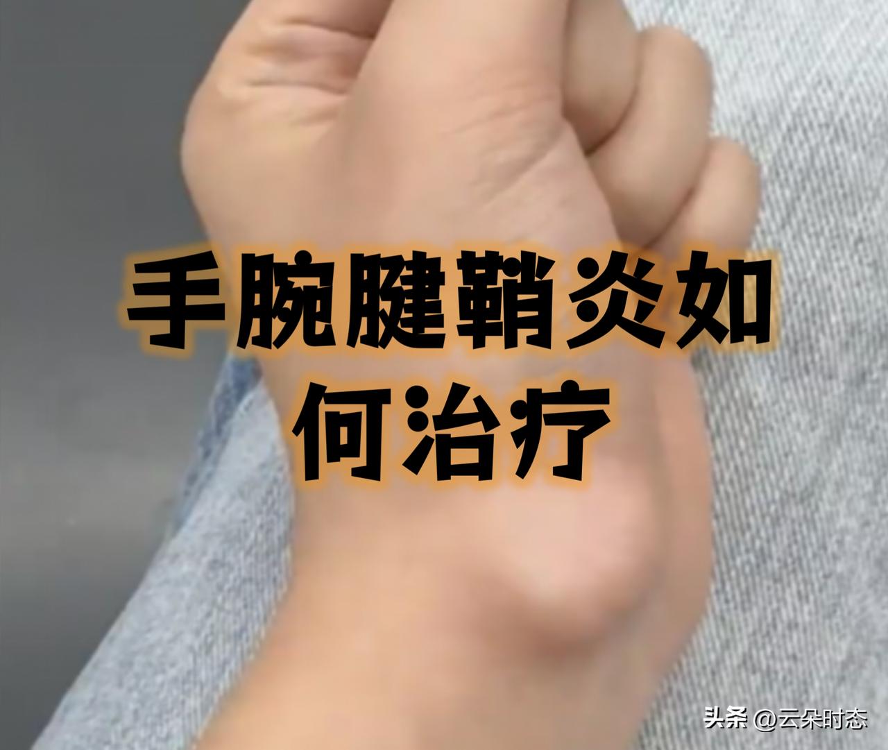 大拇指疼得“咔咔”响？光靠休息能自愈吗？医生大实话：别硬扛！

大拇指根部疼得厉