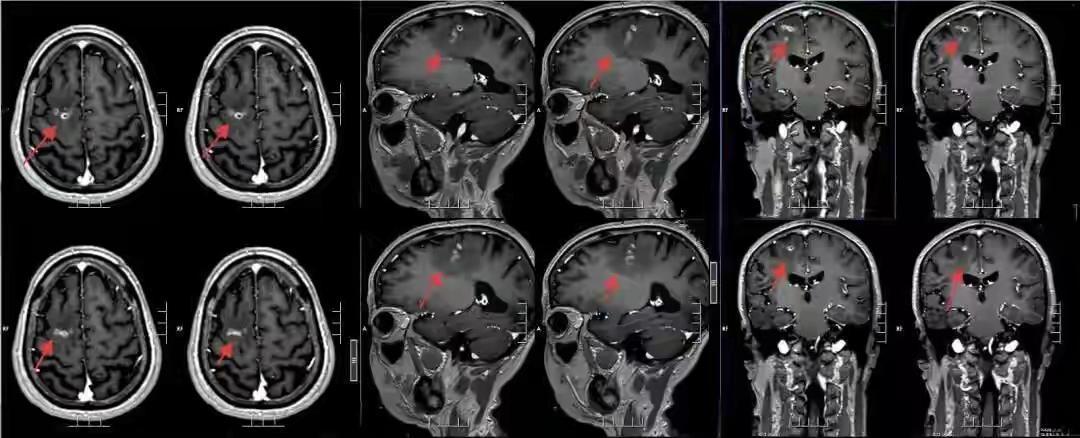广东一男子20多年不敢一个人出门，医生从他脑中取出10厘米活虫

近日，广东一名