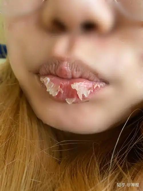 撕嘴皮想必大家都不陌生，在嘴巴很干的时候，就会产生死皮，这时可能许多人都会毫不犹