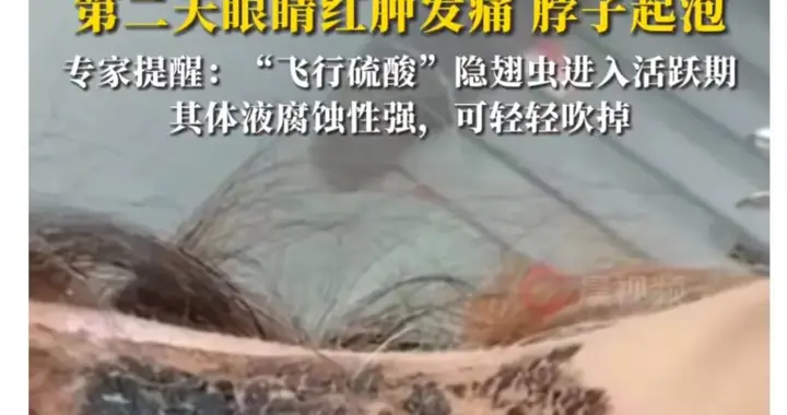 有人因此“毁容”！近期这种虫子很活跃，遇到千万不能拍！正确应对只需一招→