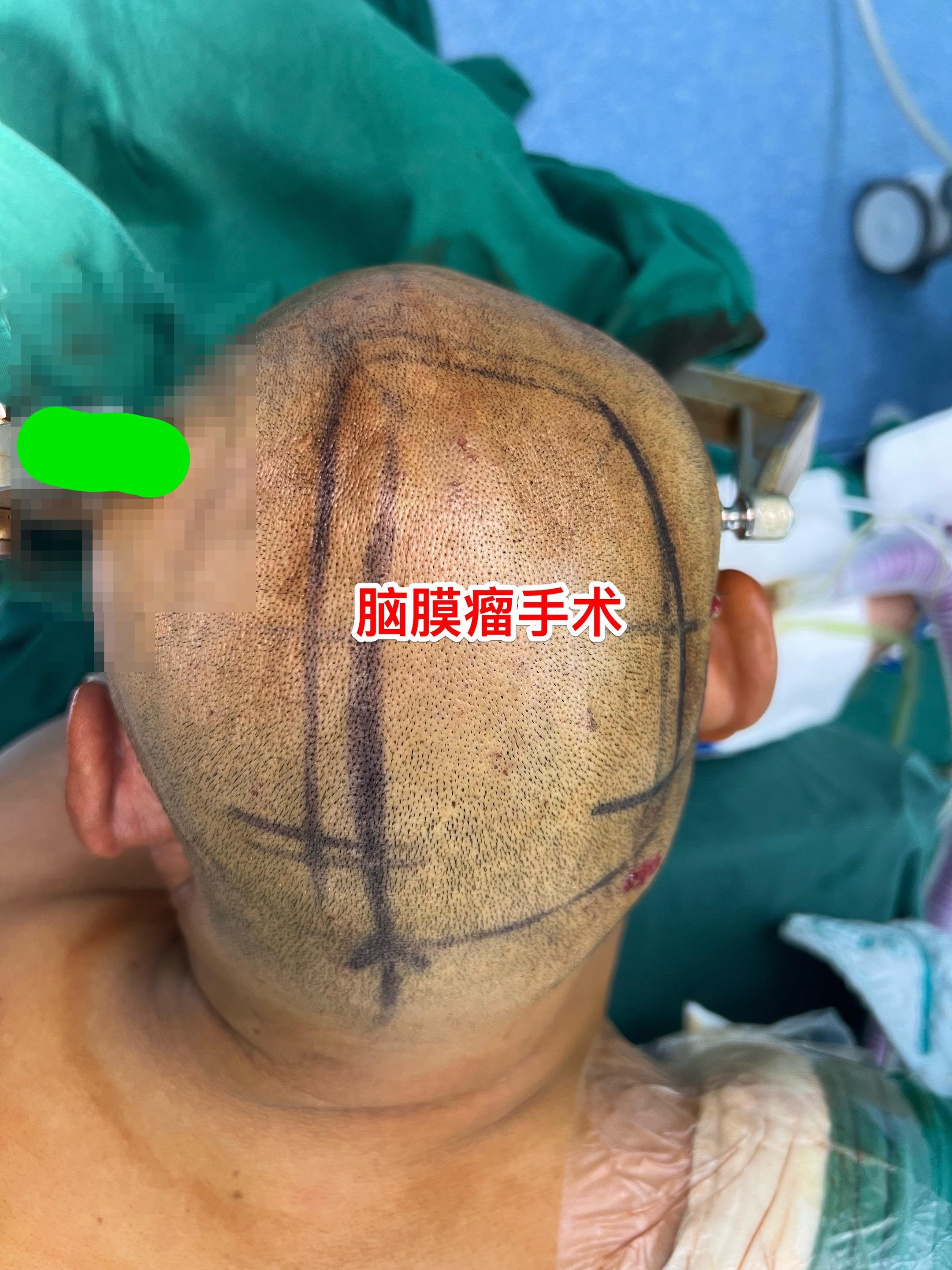 55岁男性因头痛发现脑膜瘤。脑膜瘤是良性肿瘤，如果有症状的话，就应该作...