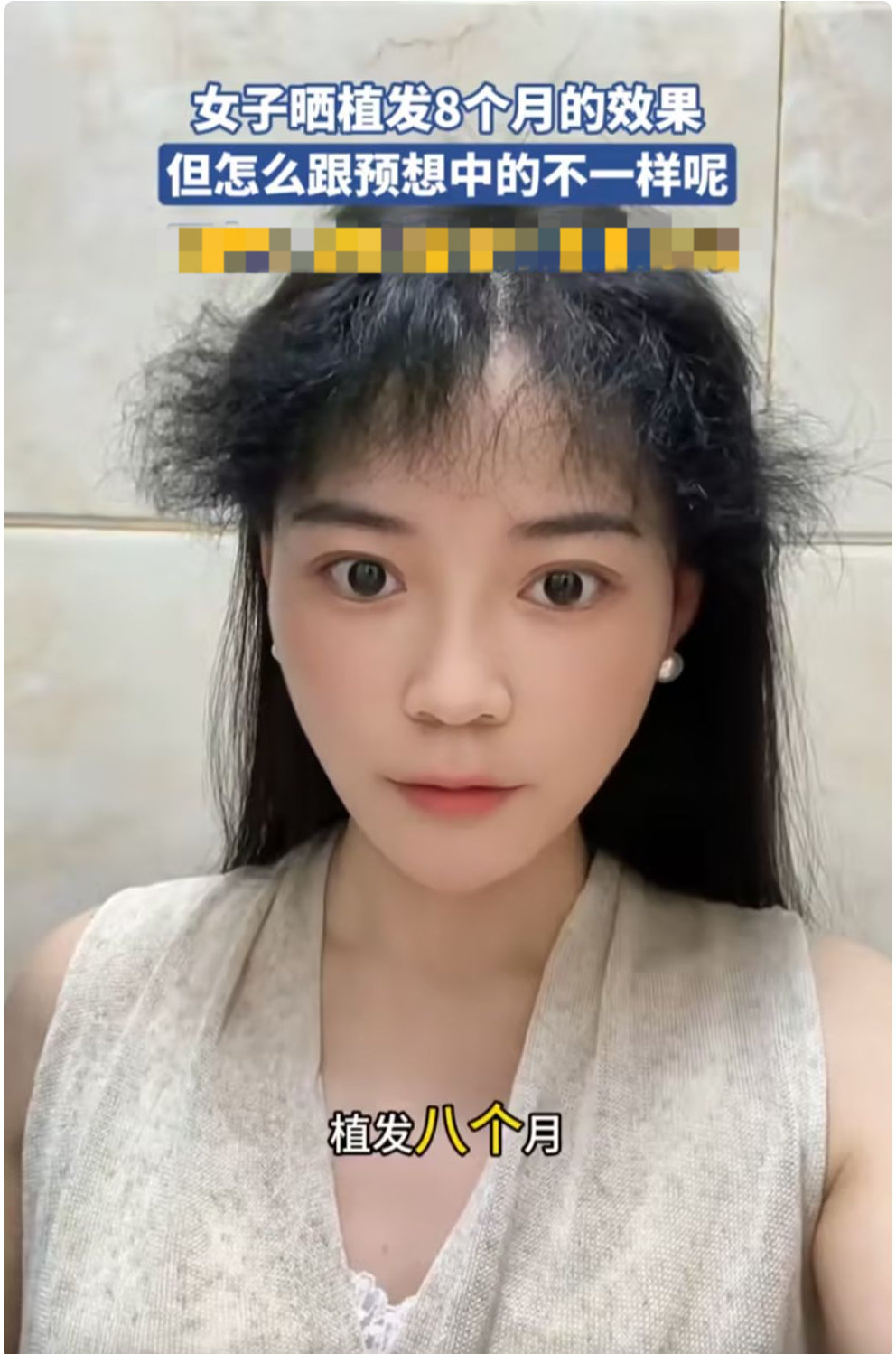女子植发8个月，刘海长成小卷毛被嘲笑，和预想完全不一样 