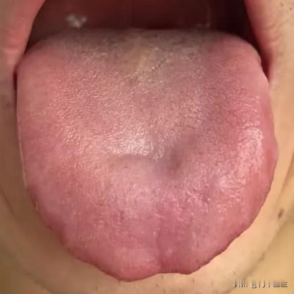 舌象分析：心气不通，阴虚火旺，下焦湿热

1. “舌尖红，鼓胀”——心火旺，心气