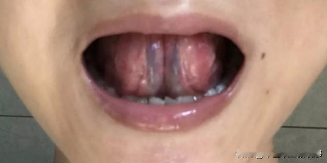 化瘀最好的方法，一是补气，二是补阳，三是疏肝，这样才能挖出血瘀之根。

1、补气