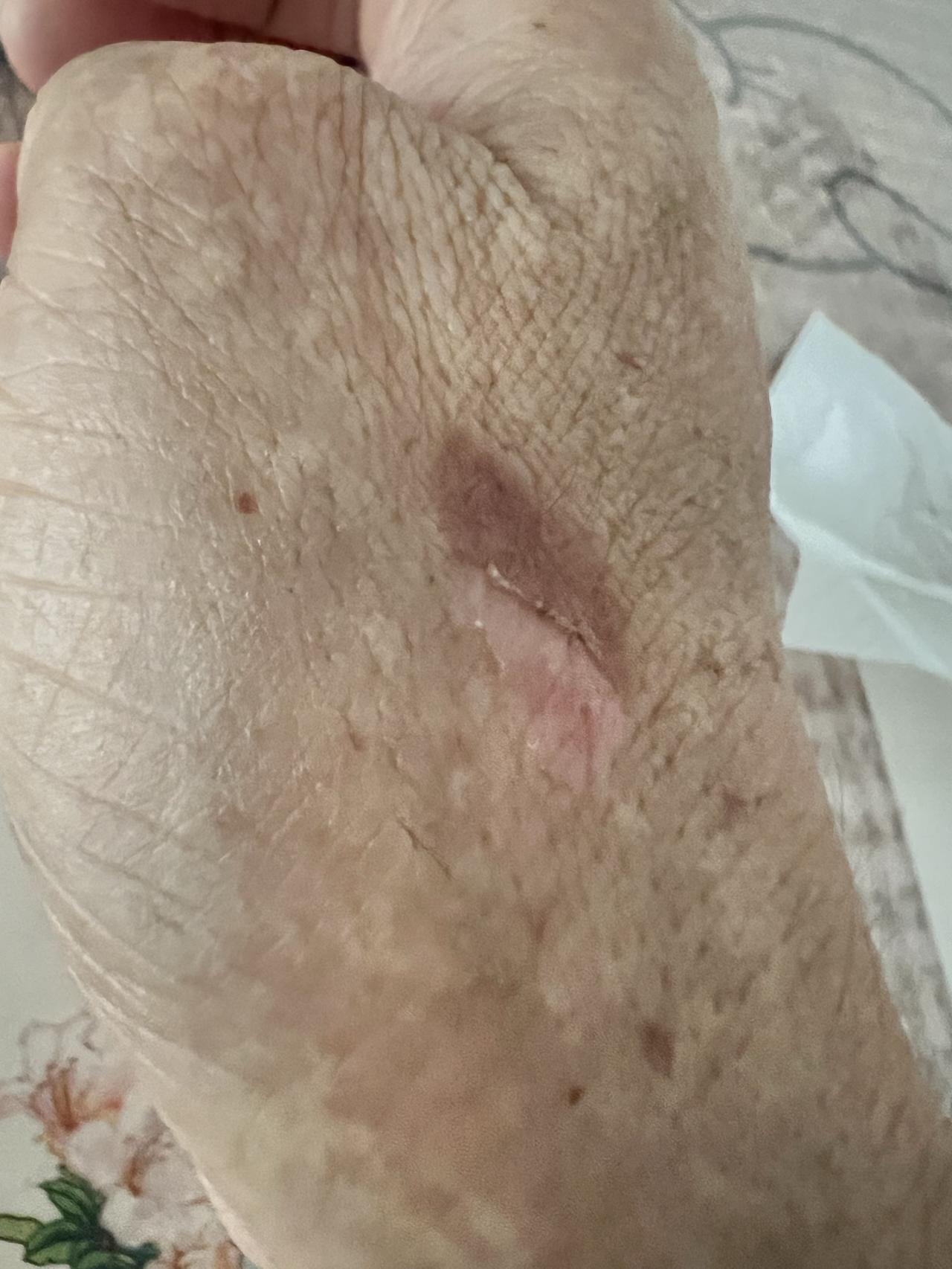 做饭烫的，看着它从起泡到消泡，到长结了，然后到这层皮揭掉，这肉看着好嫩，要是都长